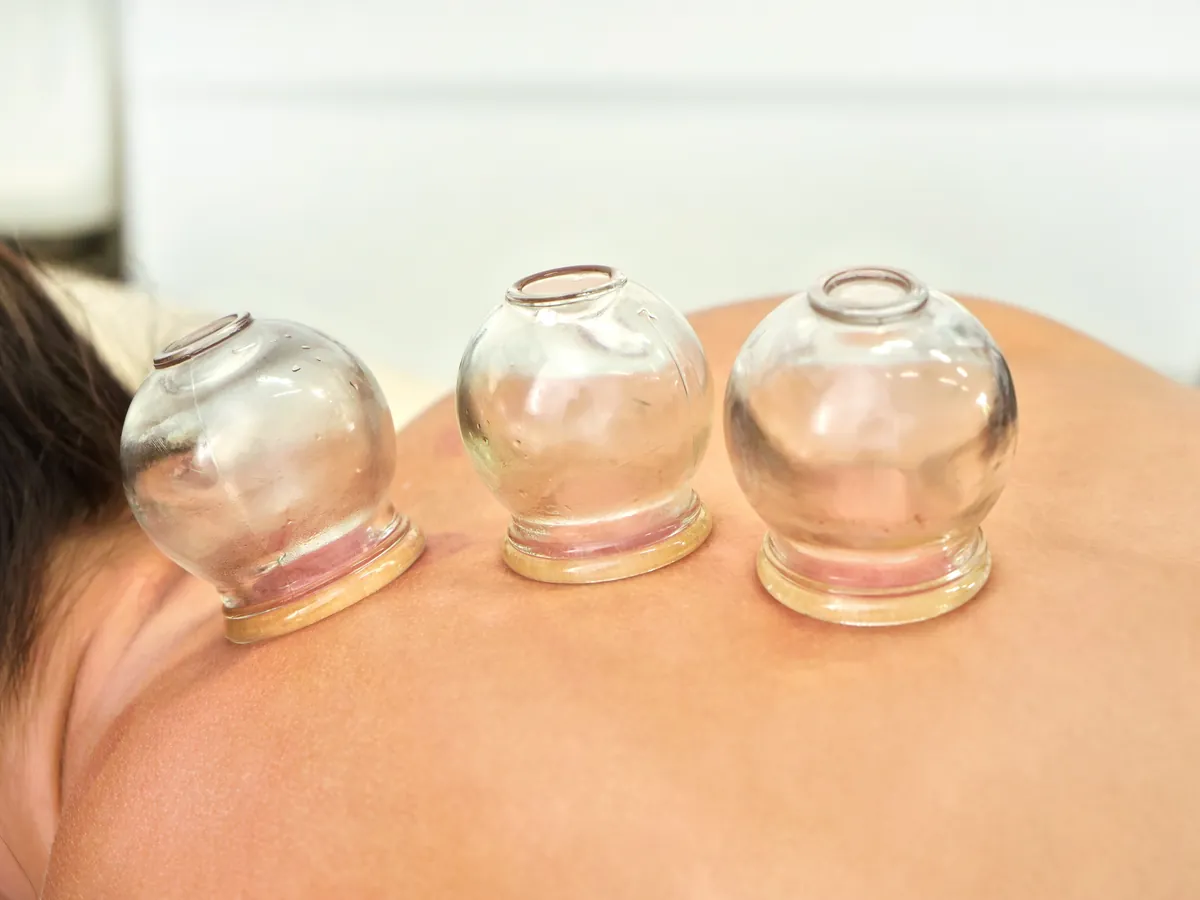 Dry cupping therapy on the back during naturopathy treatment in Haridwar