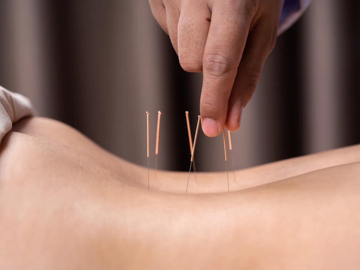 Acupuncture needle insertion on the back during naturopathy treatment in Haridwar