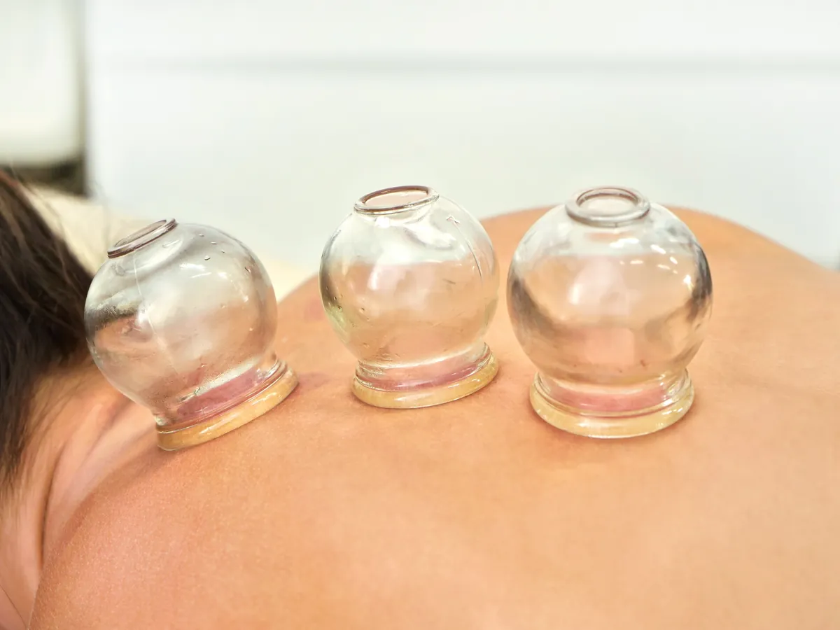 Fire cupping therapy on the back for muscle pain during the Ayurvedic Pain Management Haridwar programme